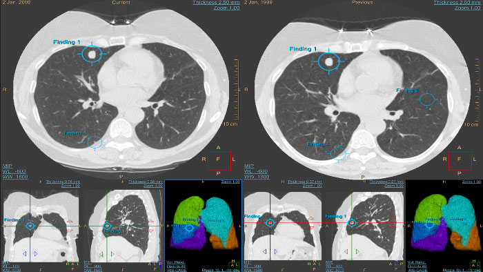CT Lung Nodule Assessment