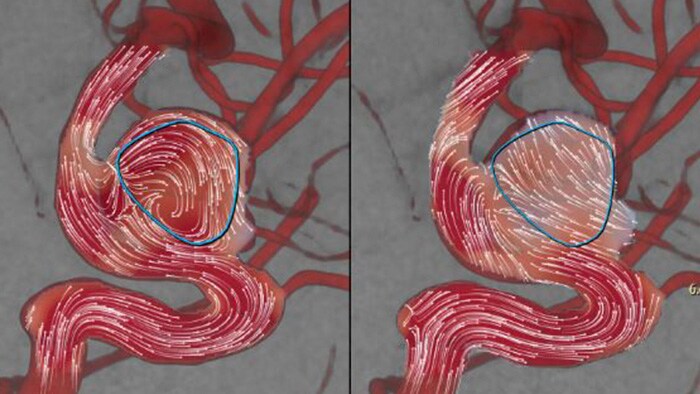 Aneurysm Flow