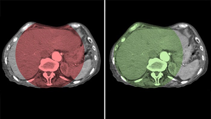 Cobertura del hígado completo con CBCT Open