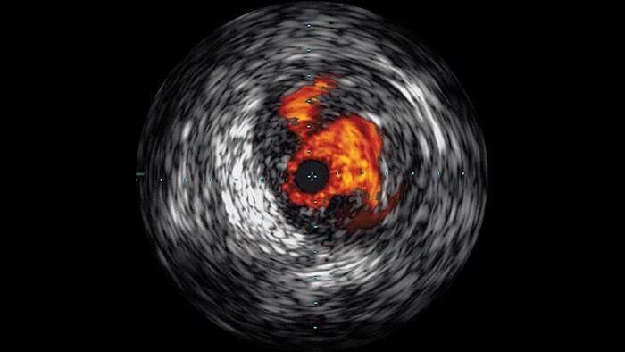 Ecografía intravascular