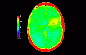 Lesión cerebral