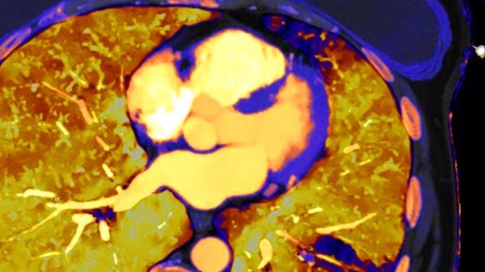 Imagen clínica de TAC con detector espectral