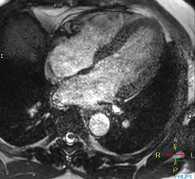 Im&aacute;genes cardiacas de aceleraci&oacute;n convencional PHH