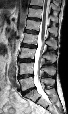 Im&aacute;genes de la columna con aceleraci&oacute;n convencional PHH