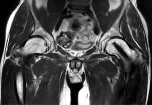 Implante SmartSpeed de Philips