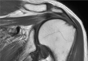 SmartSpeed MotionFree de Philips