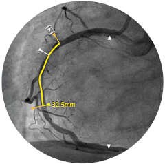 intrasight sync4 2 ivus co reg